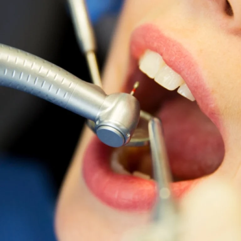 Root-Canal-Treatment